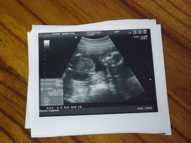 利用超音波觀察胎兒